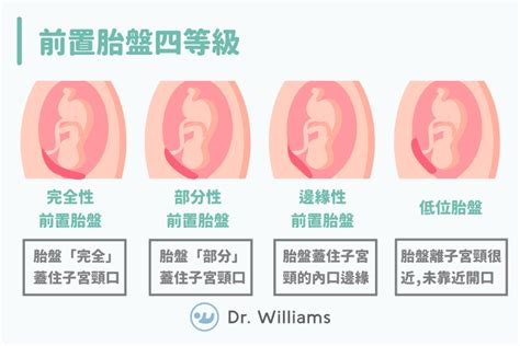 胎盤靠近子宮頸|前置胎盤一點也不可怕！讓醫師教妳平時怎麼做！ 